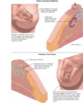 intraductalis papilloma vs csatorna ectasia
