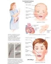 Fetal Alcohol Syndrome
