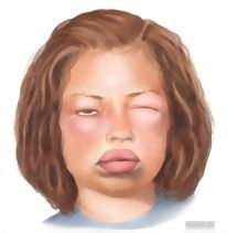 Apotek Online: Hives dan Angioedema