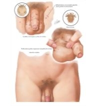 Illustration of Dermatoses II - Arthropodic Origin from the Netter Collection