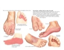 Illustration of Diagnosis of Tinea Pedis from the Netter Collection