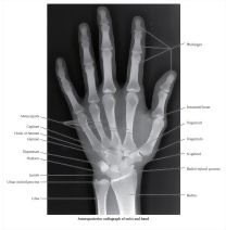 Anteroposterior Radiograph of the Wrist and Hand