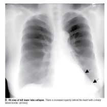 Search Strategy: Lungs, Atelectasis
