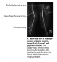 MRA With Maximum Intensity Projection (MIP) of Relatively Normal ...