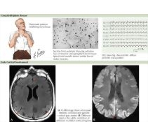Transmissible Spongiform Encephalopathy