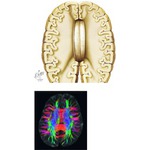 Corpus Callosum