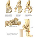 Injury to Tarsometatarsal (Lisfranc) Joint Complex