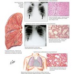 Collagen-Vascular Disease: Lung Involvement