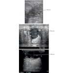 Ultrasound imaging of abscesses
