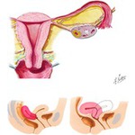 Illustration of Female Reproductive Organs: Uterus and Vagina  from the Netter Collection