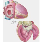 Illustration of Atrial septal defect and ventricular septal defect from the Netter Collection