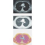Illustration of Imaging of the Lungs: Axzial CT Cross Section from the Netter Collection