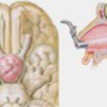 Illustration of Pituitary tumors (pituitary adenomas)  from the Netter Collection