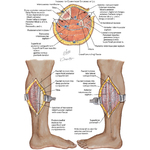 Longitudinal Incision Leg Incisions for Compartment Syndrome of Leg