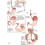 Aerophagia and Belching