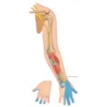 Common Sites of Upper Extremity Nerve Entrapment